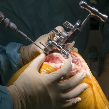 Joint Replacement Surgery