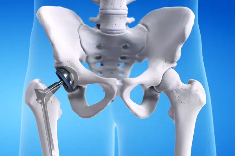 Revision Hip Replacement
