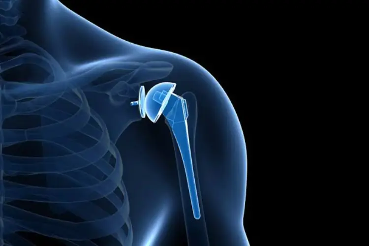 Shoulder Replacement